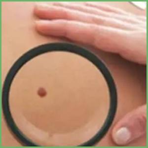 Blackish pigmentation skintags neck urderarms diabetes insulin-resistance risk experts